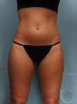 Coolsculpting Case 8 Before
